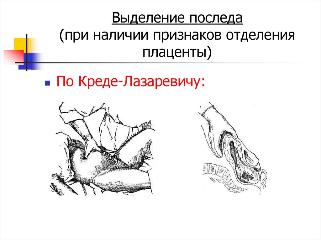 При наличии признаков. Методы отделения плаценты Альфельда. Метод отделения последа Лазаревича. Методы выделения последа по Креде Лазаревичу. Наружный метод выделения отделившегося последа.