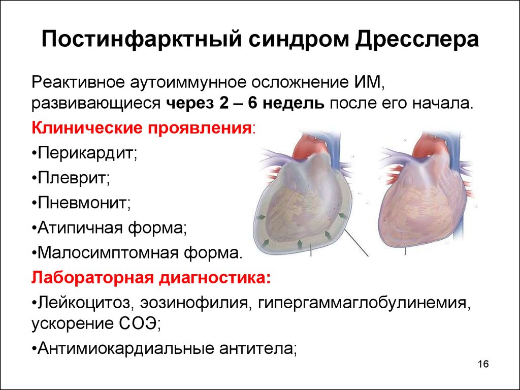 Инфаркт миокарда последствия