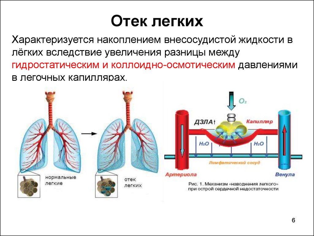 Легкие заполнены жидкостью. Гидростатический отёк лёгких.