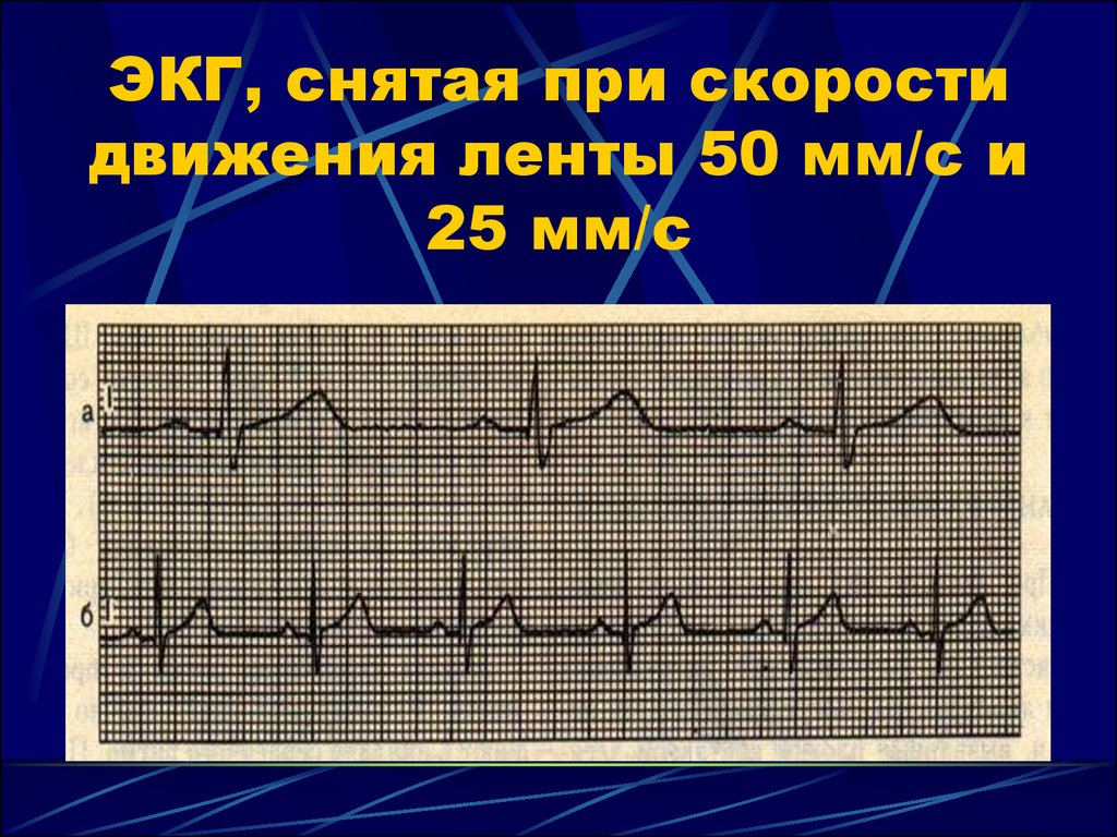 Экг снятые. ЭКГ при скорости 25 мм/с. ЭКГ 25 мм/с одна клетка. ЭКГ 50 мм/с. ЭКГ скорость 25 мм/с.