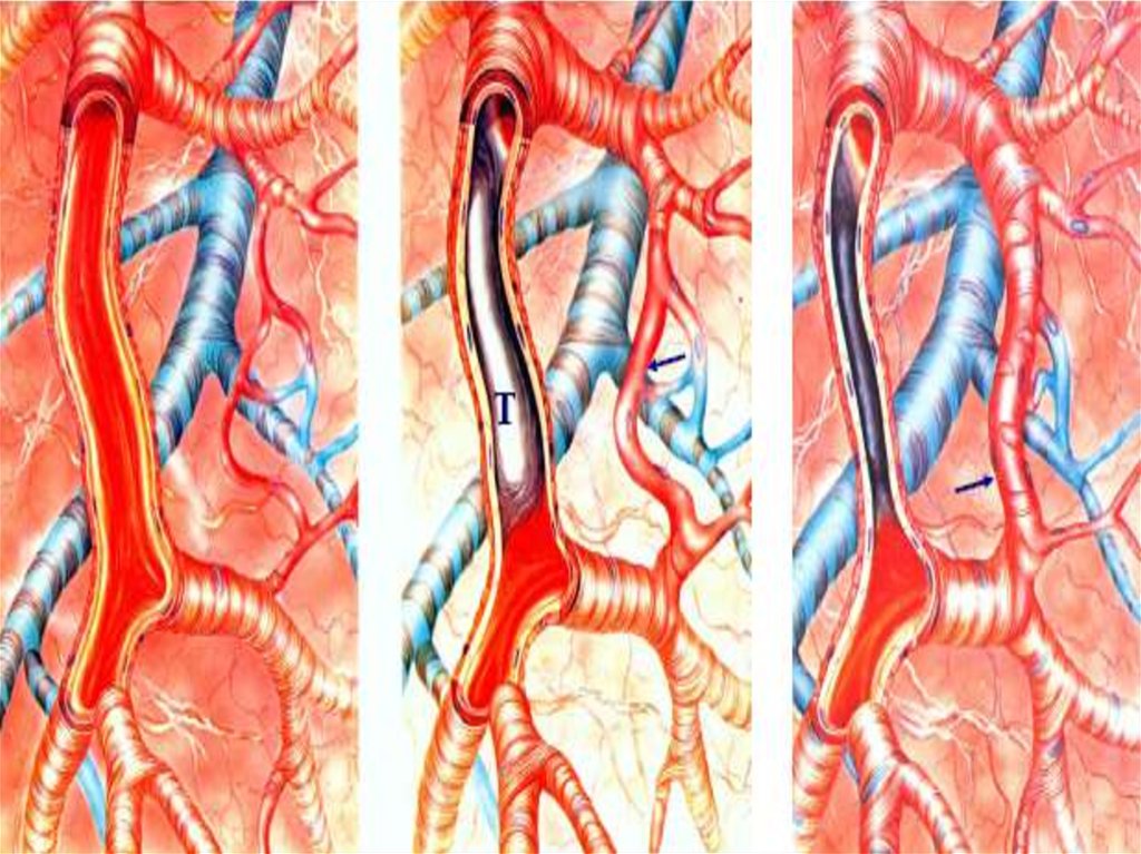 Тромбоз артерия и вена. Сосудистое образование. Дефицит кровоснабжения. Хроническая артериальная непроходимость.