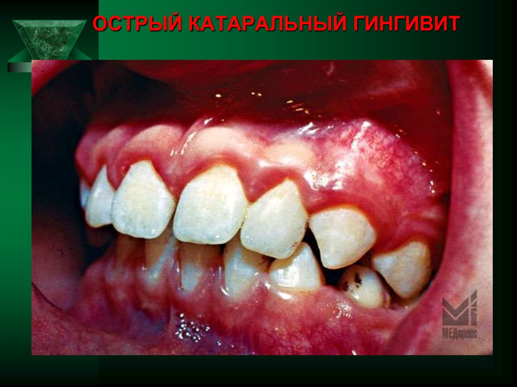 ОСТРЫЙ КАТАРАЛЬНЫЙ ГИНГИВИТ