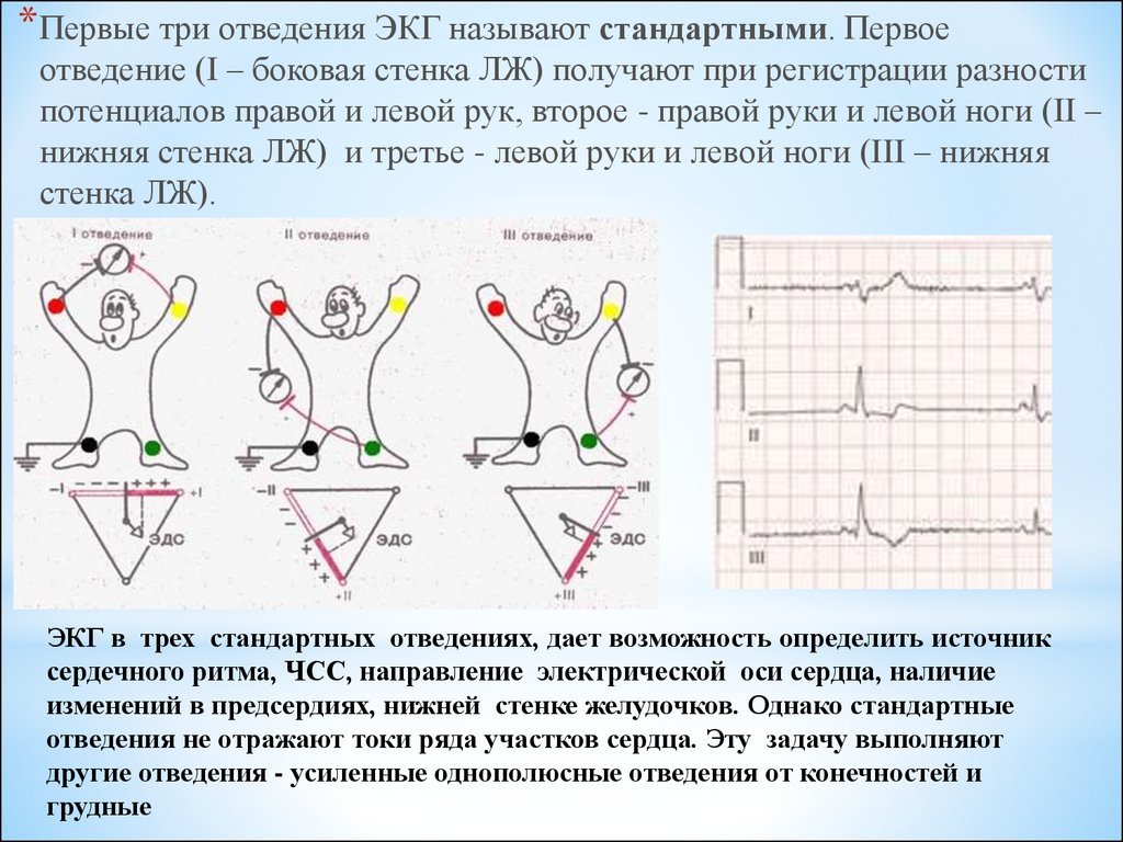 Отведения экг. Первое стандартное отведение ЭКГ. 3 Отведение на ЭКГ. ЭКГ во 2 стандартном отведении. 3 Стандартное отведение ЭКГ.