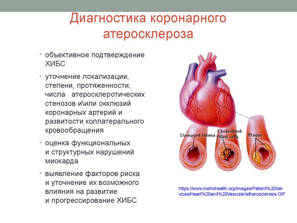 Хроническая ишемическая болезнь сердца картинки