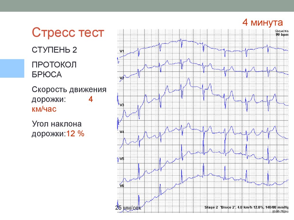 Протокол брюса. Тредмил тест протокол. Стадия 4 протокола Брюса. Тредмил протокол по Брюсу.