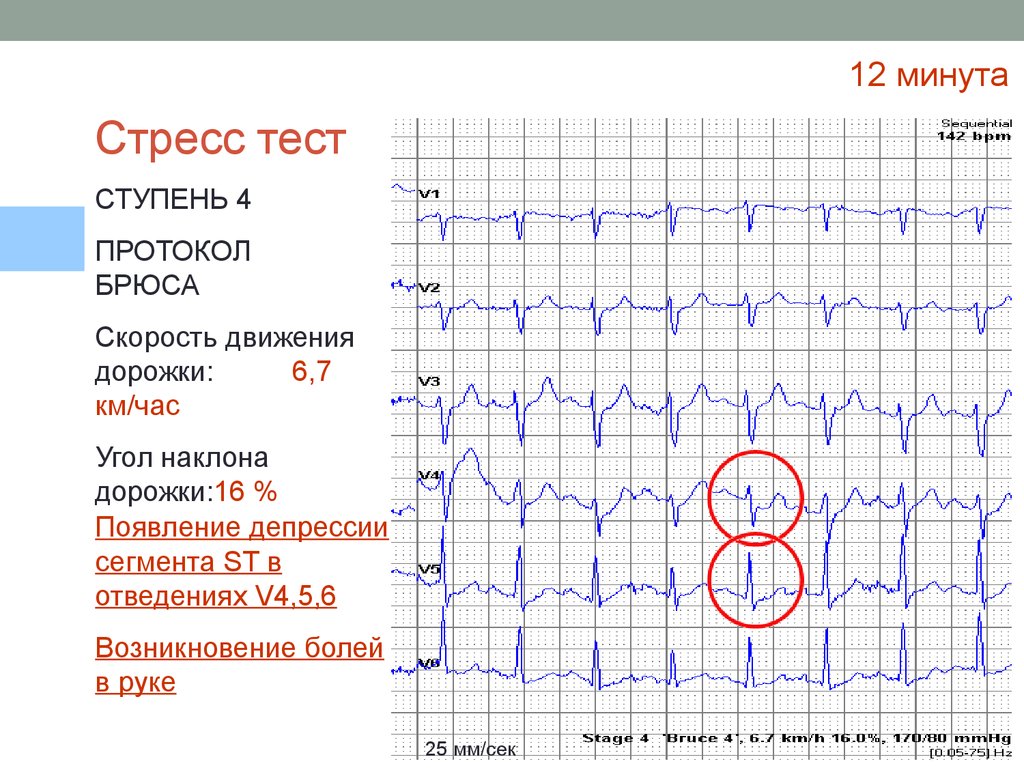 Протокол брюса. Стресс тест ЭКГ. Зачет ЭКГ. Тесты по ЭКГ С ответами для врачей. ЭКГ тест по фото.