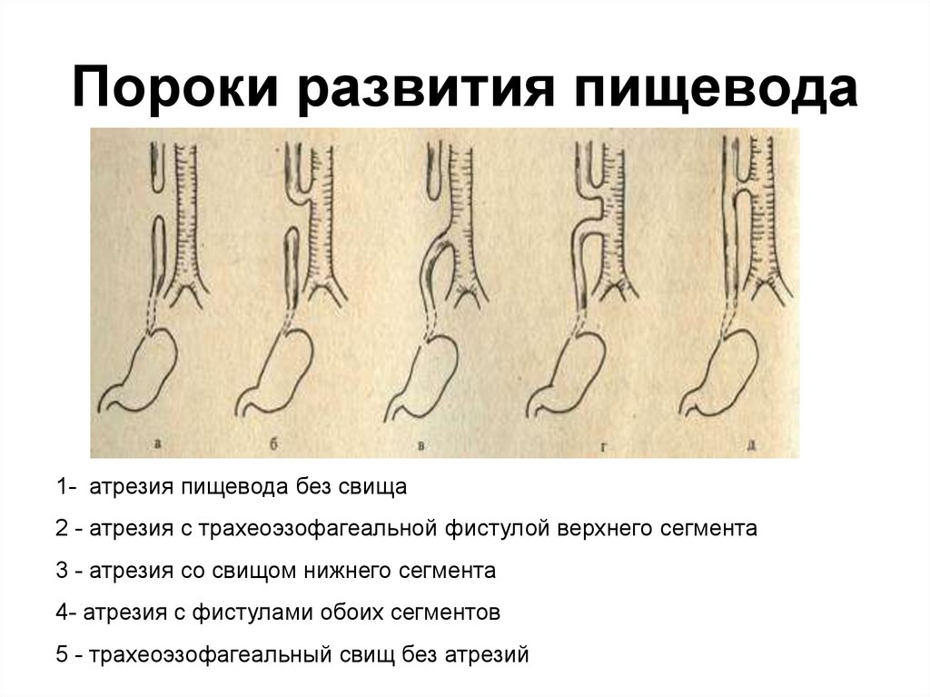 Атрезия это. Анатомические формы атрезии пищевода. Атрезия пищевода классификация. Классификация атрезии пищевода клинические. Формы атрезии пищевода у детей.