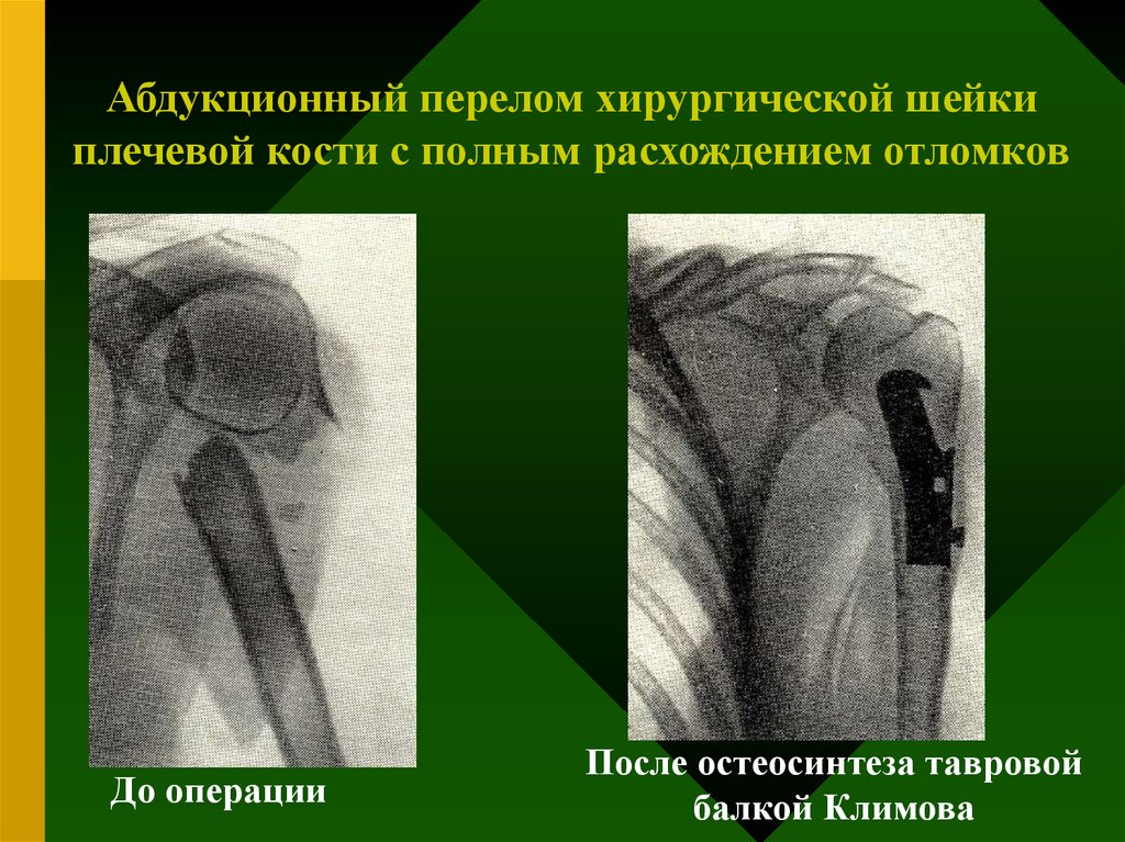 Вывих плеча презентация