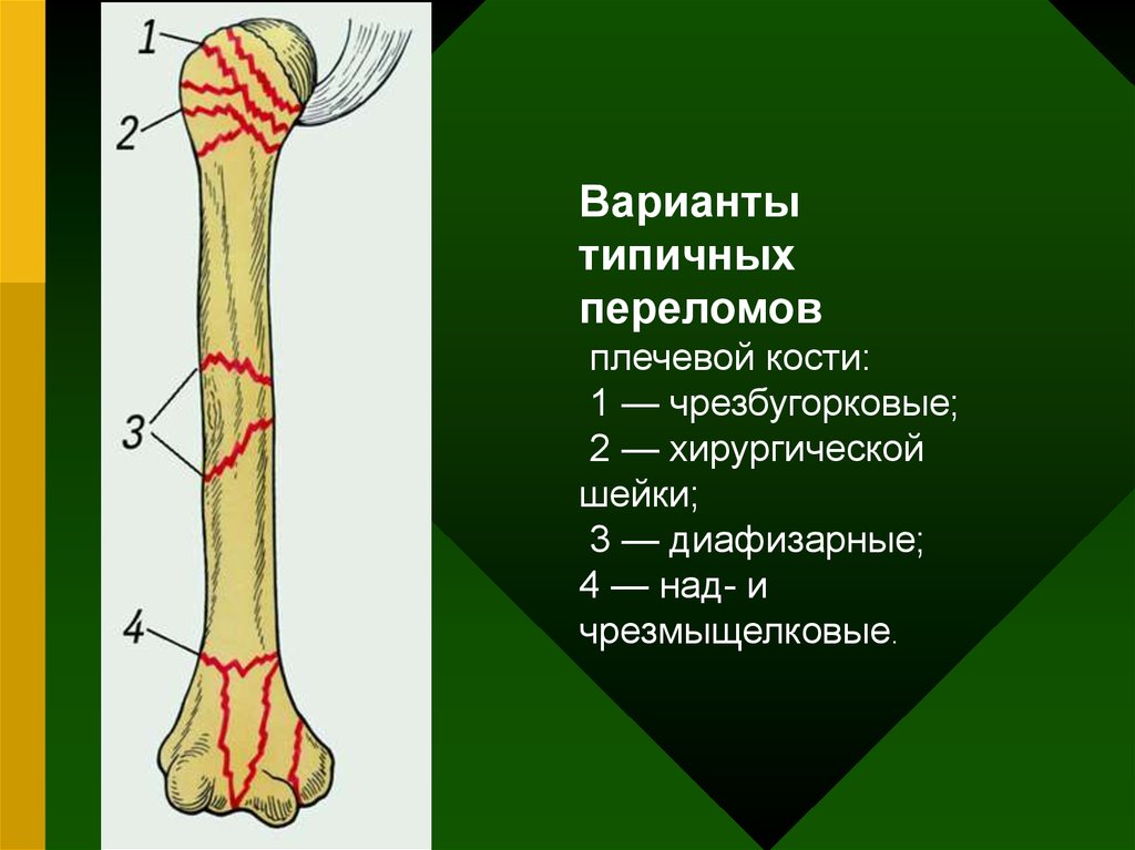 Хирургическая кость. Хирургическая шейка плечевой кости (Collum Chirurgicum Humeri). Разгибательный перелом плечевой кости. Хирургическая шейка плечевой кости перелом. Надбугорковые переломы плечевой кости.