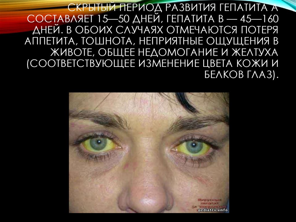 Гепатит а это желтуха. Желтые глаза при гепатите.