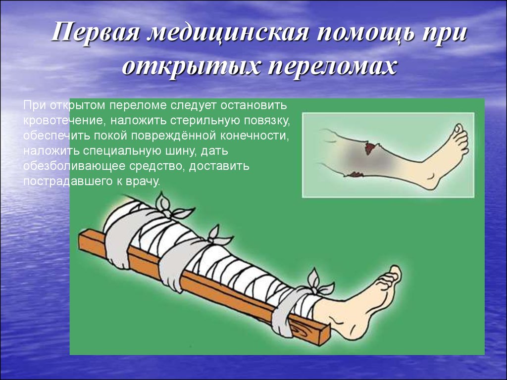 При открытом переломе накладывают