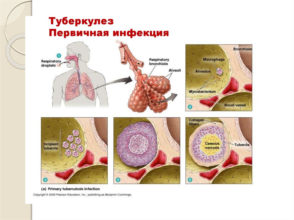 Туберкулез презентация на английском