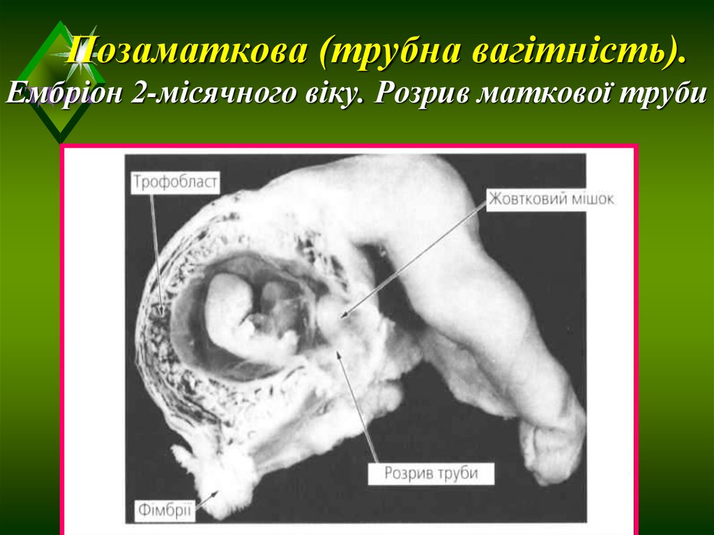 Позаматкова (трубна вагітність). Ембріон 2-місячного віку. Розрив маткової труби