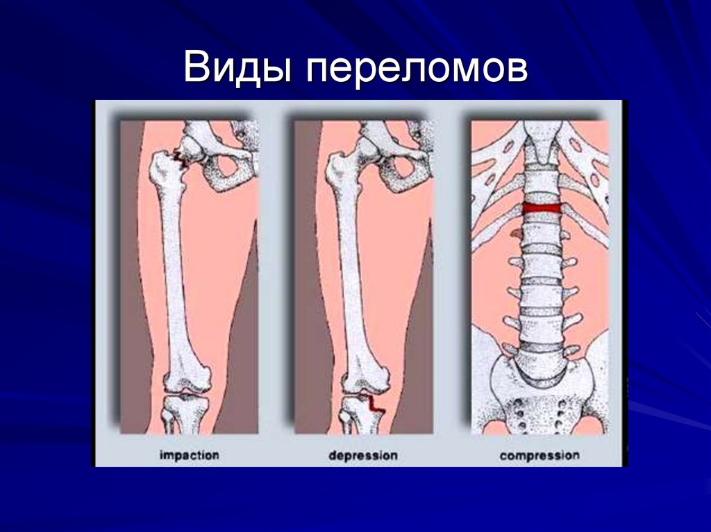 Перелом спины фото