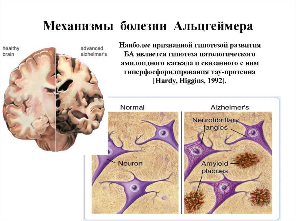 Болезнь айцгельмера это что. Механизм развития болезни Альцгеймера. Холинергическая теория болезни Альцгеймера. Патогенез Альцгеймера. Болезнь Альцгеймера презентация.