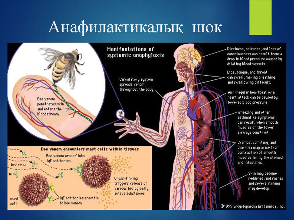 Клиническая картина анафилактического шока