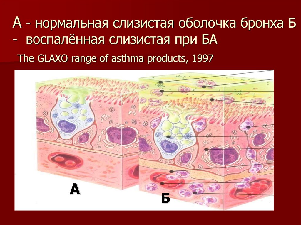 Нормальная слизистая оболочка. Слизистая оболочка бронха. Слизистая оболочка у легкого. Воспаление слизистой оболочки.