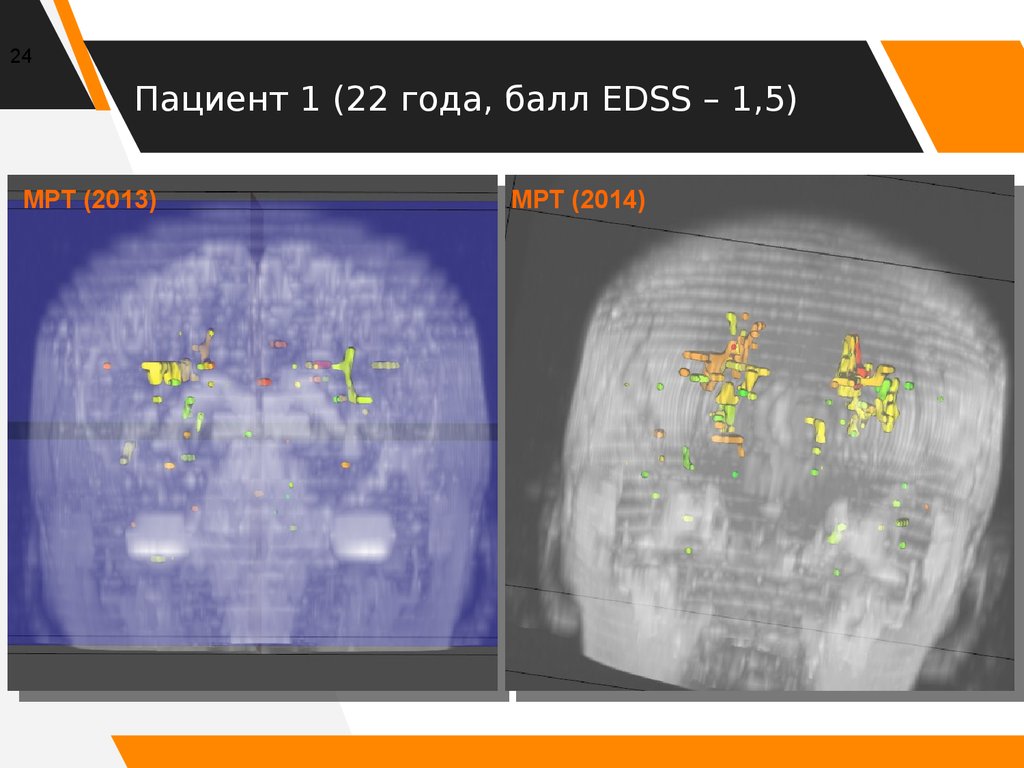 Пациент 1 (22 года, балл EDSS – 1,5)