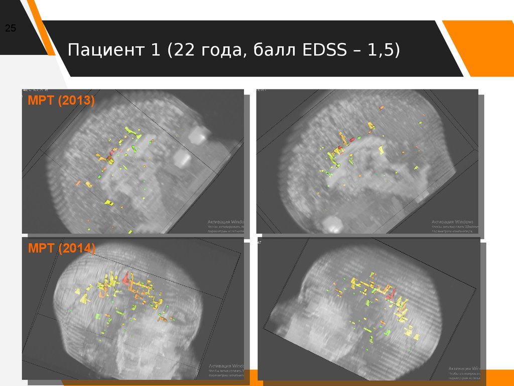Пациент 1 (22 года, балл EDSS – 1,5)