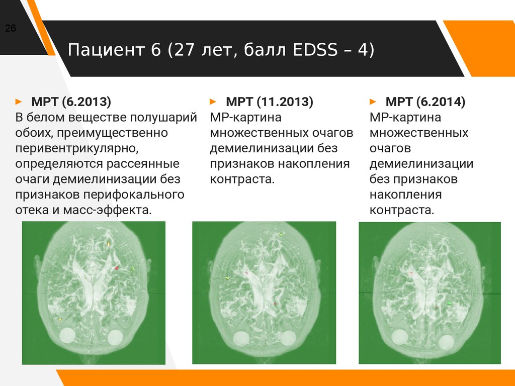 Пациент 1 (22 года, балл EDSS – 1,5)