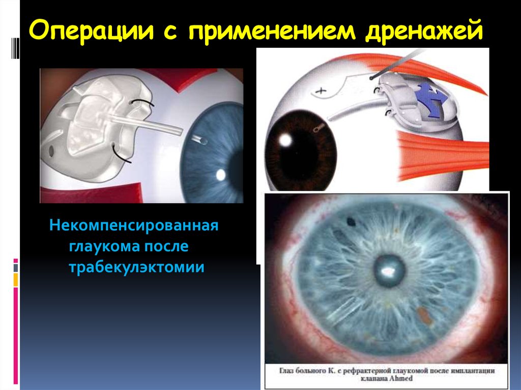 Больница операция глаукомы. Хирургическая операция глаукомы. Операции при открытоугольной глаукоме.