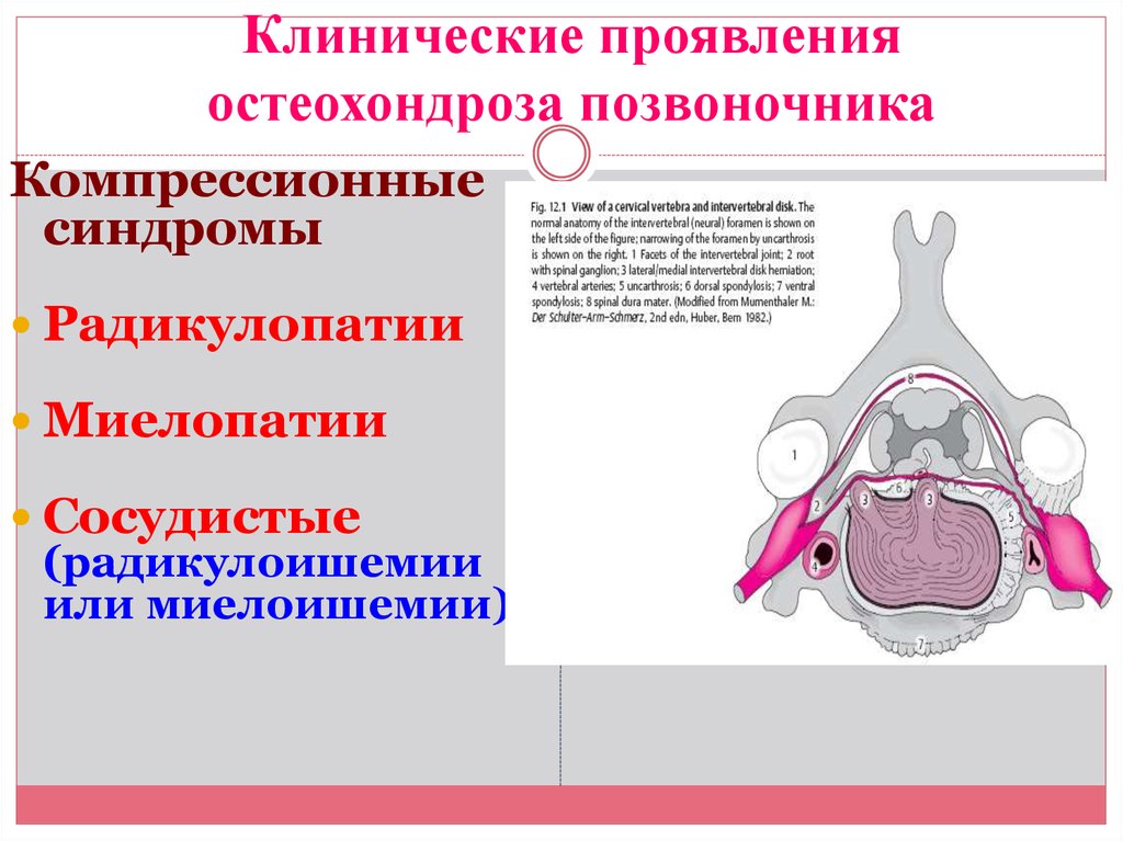 Радикулоишемия