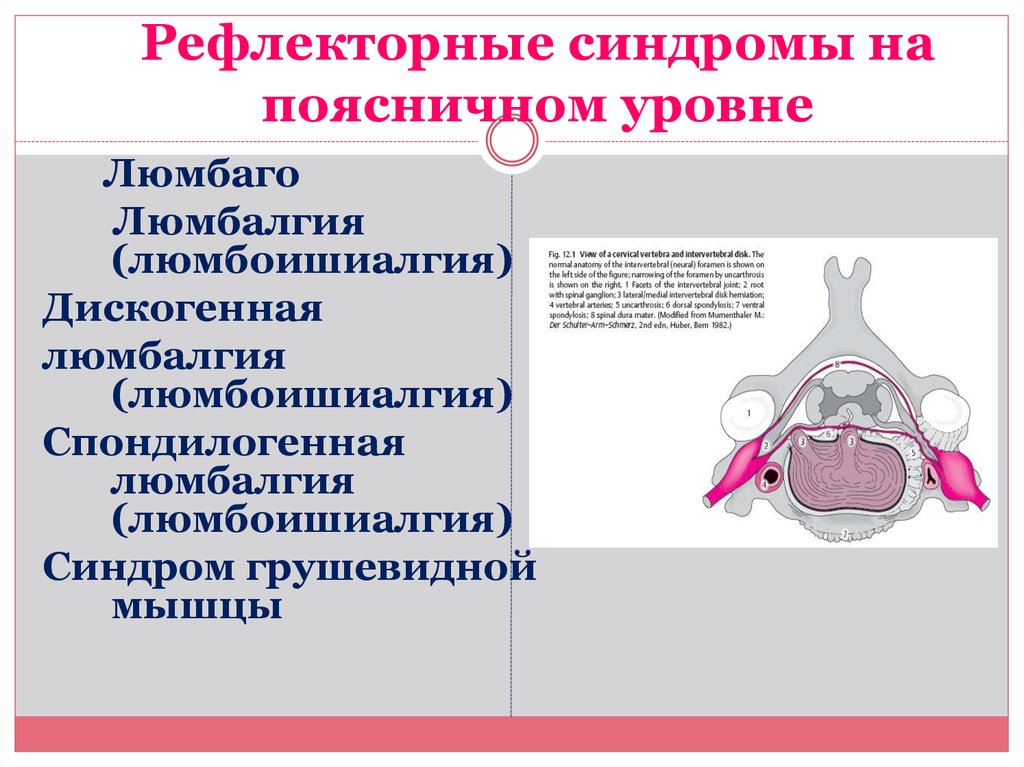 Люмбаго с ишиасом поясничного отдела. Рефлекторный синдром. Люмбаго люмбалгия люмбоишиалгия. Поясничные рефлекторные синдромы:. Люмбалгия поясничного отдела.