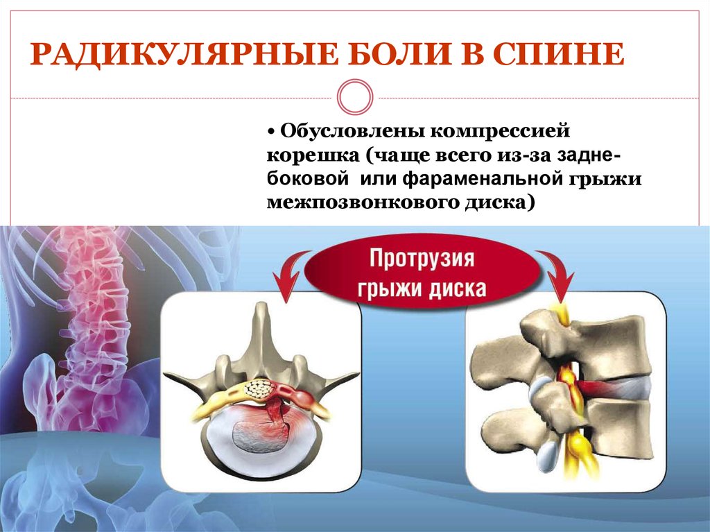 Компрессия корешков поясничного отдела