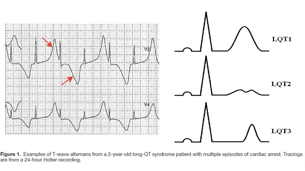 Удлиненное qt у ребенка. Удлинённый qt на ЭКГ. Синдром удлиненного qt на ЭКГ. Синдром удлиненного интервала qt на ЭКГ. Удлиненный интервал qt на ЭКГ что это такое.
