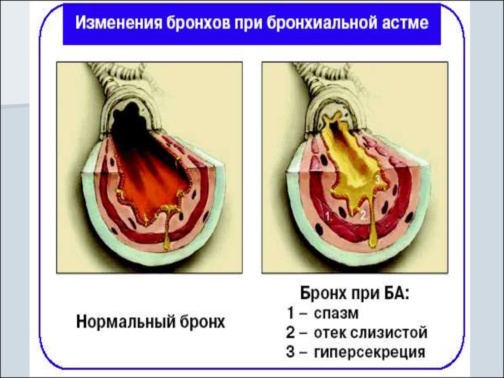 Спазм бронхов. Легкие астматика в разрезе. Аллергический синдром при бронхиальной астме. Синдром бронхиальной эктазии. Бронхиальная гиперсекреция это.