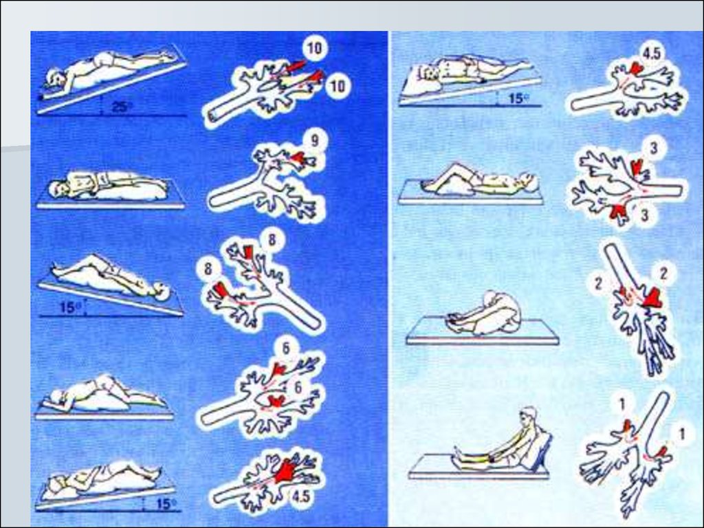 Дренажное положение. Постуральный дренаж ЛФК. Постуральный дренаж положения. Дренажные положения для отхождения мокроты.