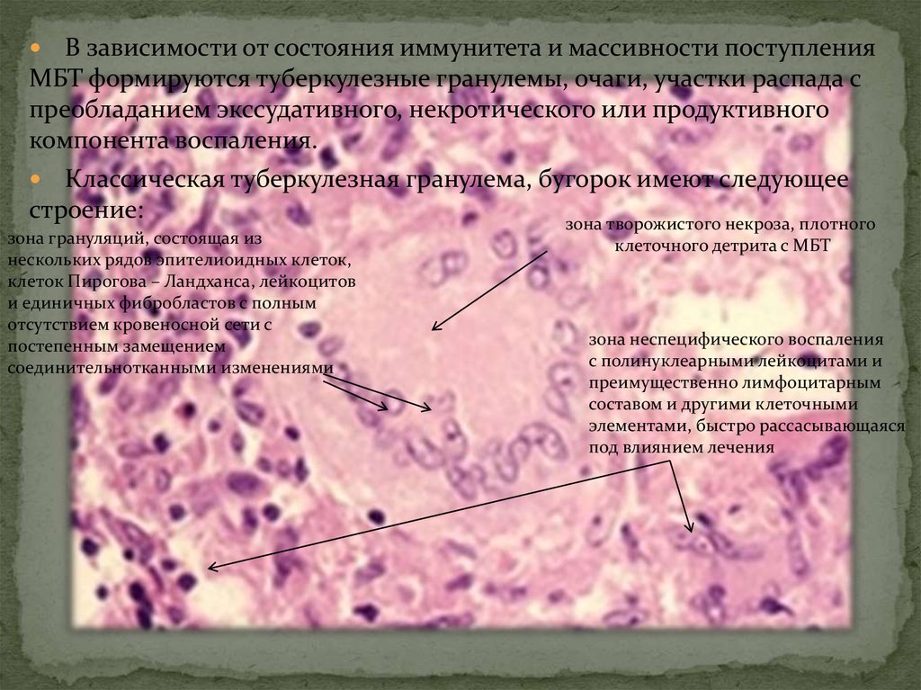 Участок распада. Гранулема строение гистология. Гистология туберкулезной гранулемы. Туберкулезная гранулема макроскопически. Туберкулезная гранулема клеточный состав.