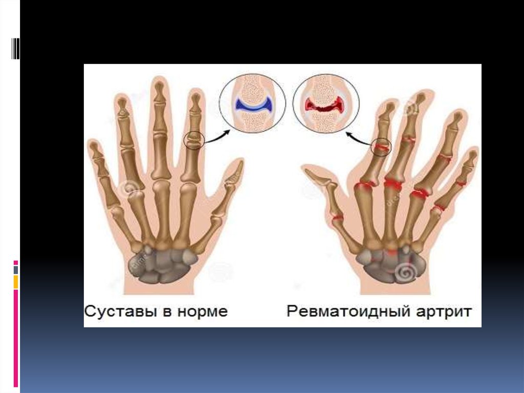 Ревматоидный артрит - презентация онлайн