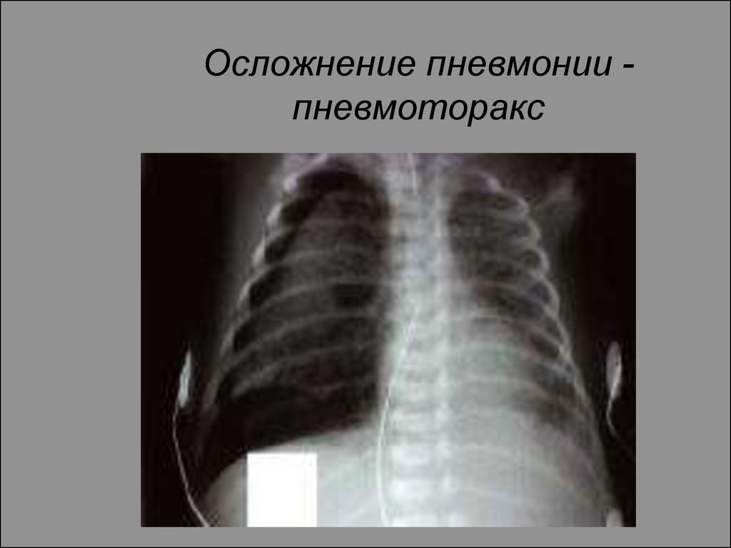 Пневмония осложнения. Осложнения пневмонии пневмоторакс. Пневмоторакс и пневмония. Пневмоторакс при пневмонии рентген у ребенка. Пневмоторакс новорожденного рентген.