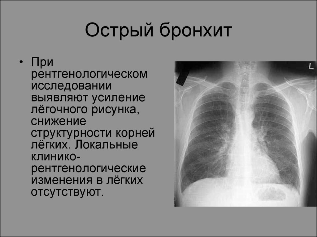Корни легких усилены. При рентгенографии легких при остром бронхите определяется. Рентген при обструктивном бронхите. Обструктивный бронхит рентген. Острый обструктивный бронхит рентген.