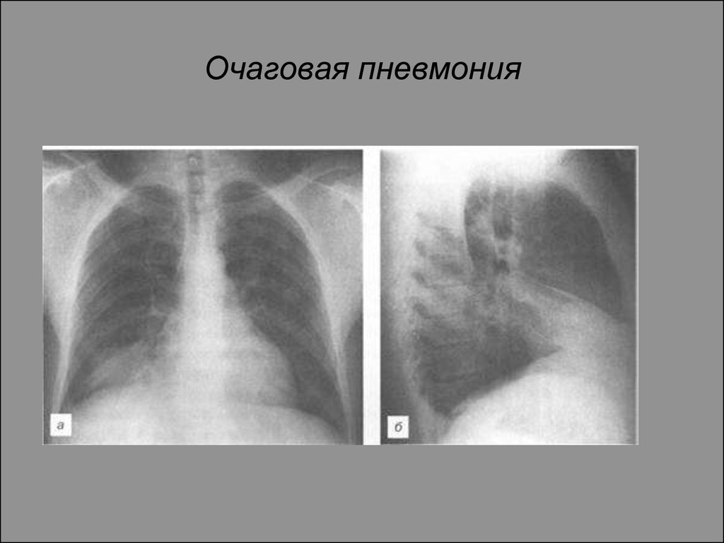 Очаговая пневмония презентация