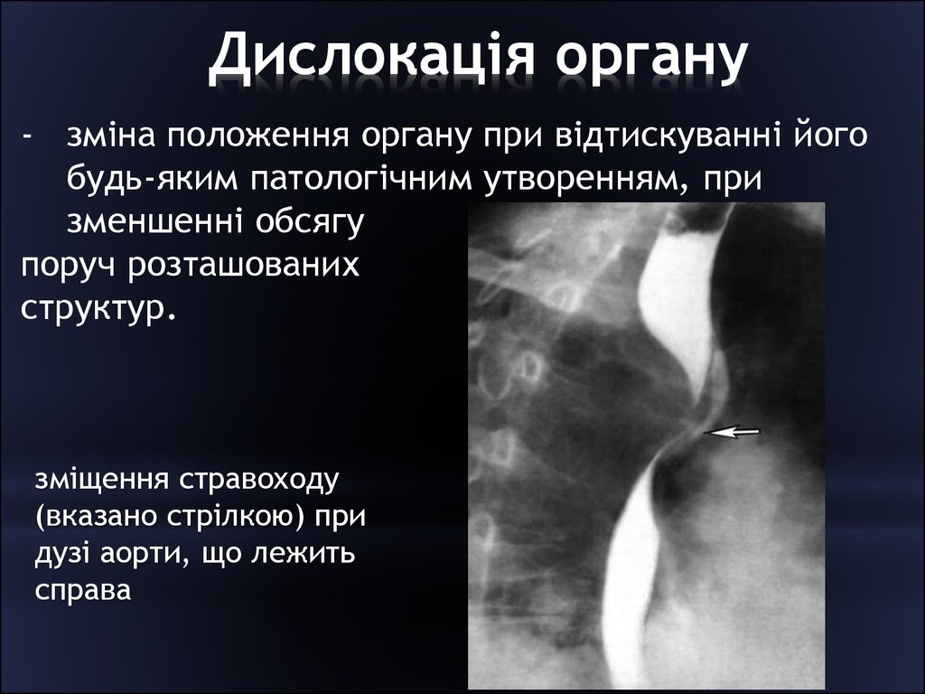 Лучевая пищевода. Синдром дислокации органа ЖКТ. Рентгенодиагностика заболеваний желудка.