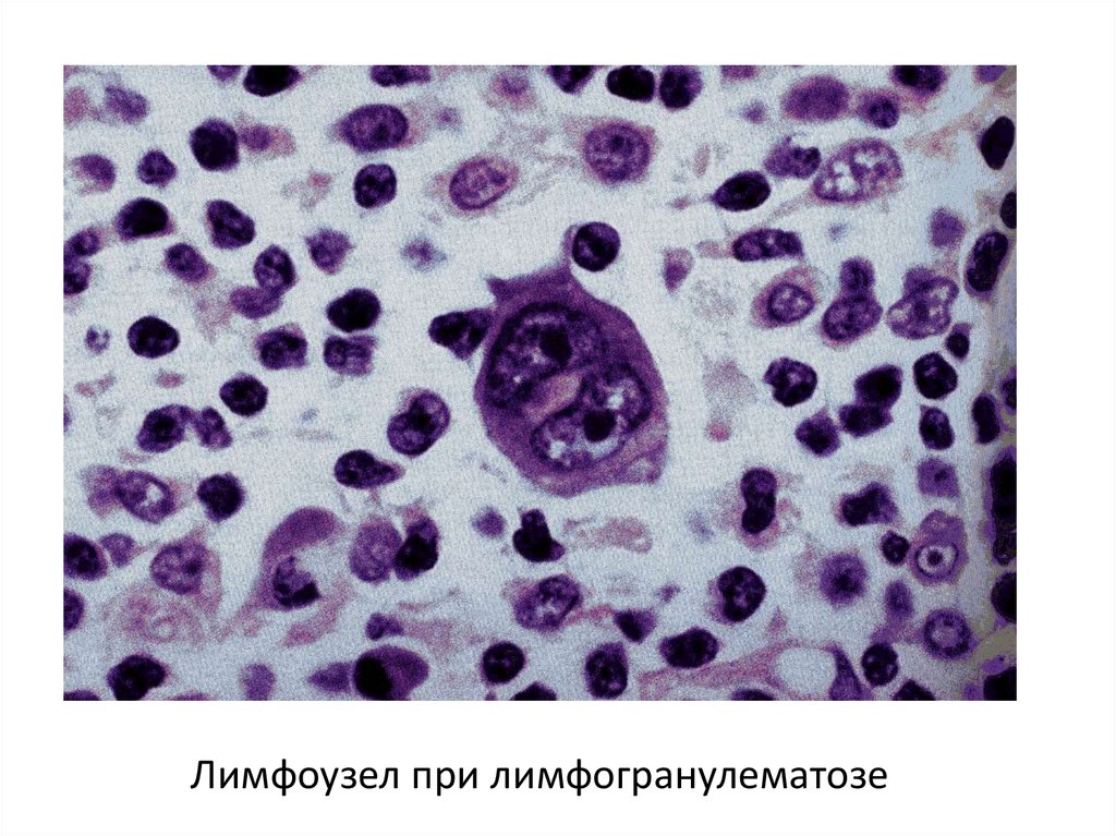 Лимфогранулематоз онкология презентация