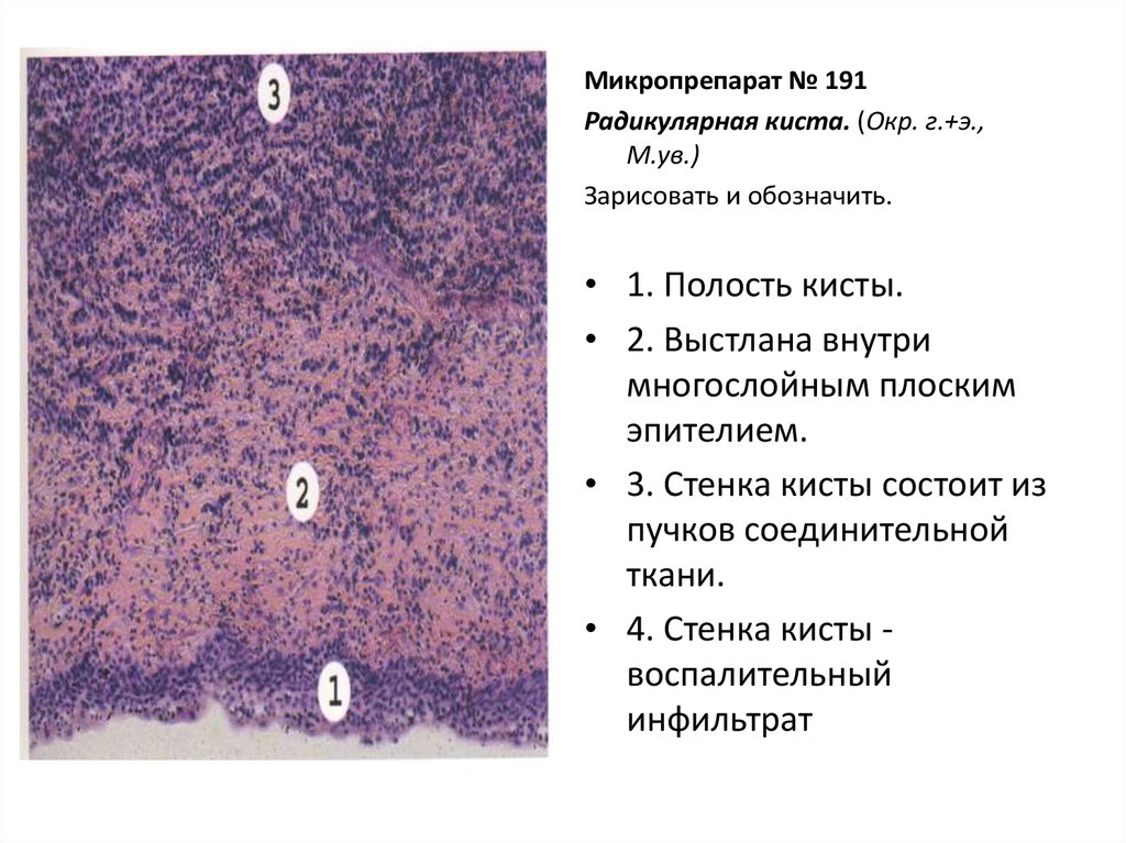 Хондрома микропрепарат рисунок