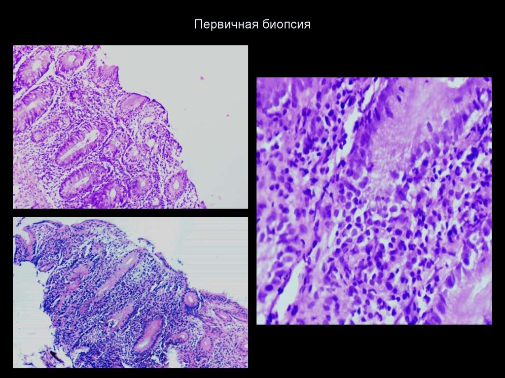 Биоптат кишки. Биопсия тонкого кишечника. Биопсия из тонкого кишечника. Биопсия тонкого кишечника по маршу.