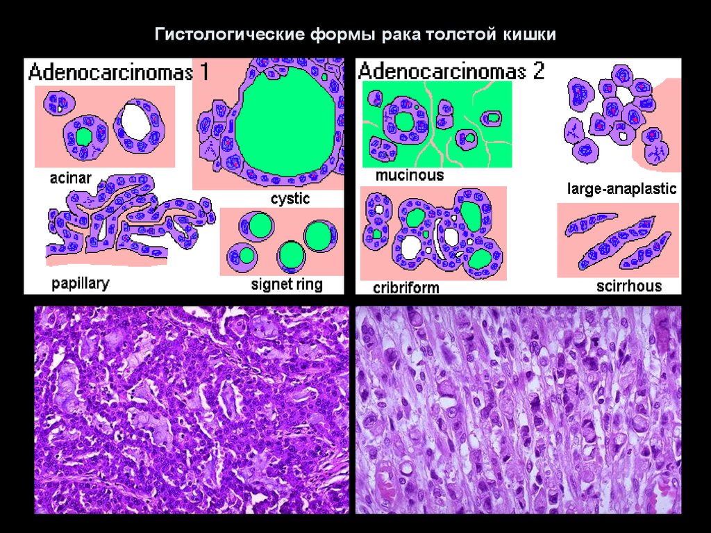 Гистологические формы рака