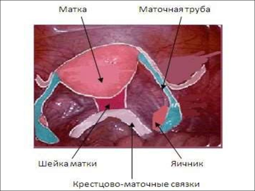 Удаление стенки матки. Топографическая анатомия маточной трубы. Длина маточной трубы.