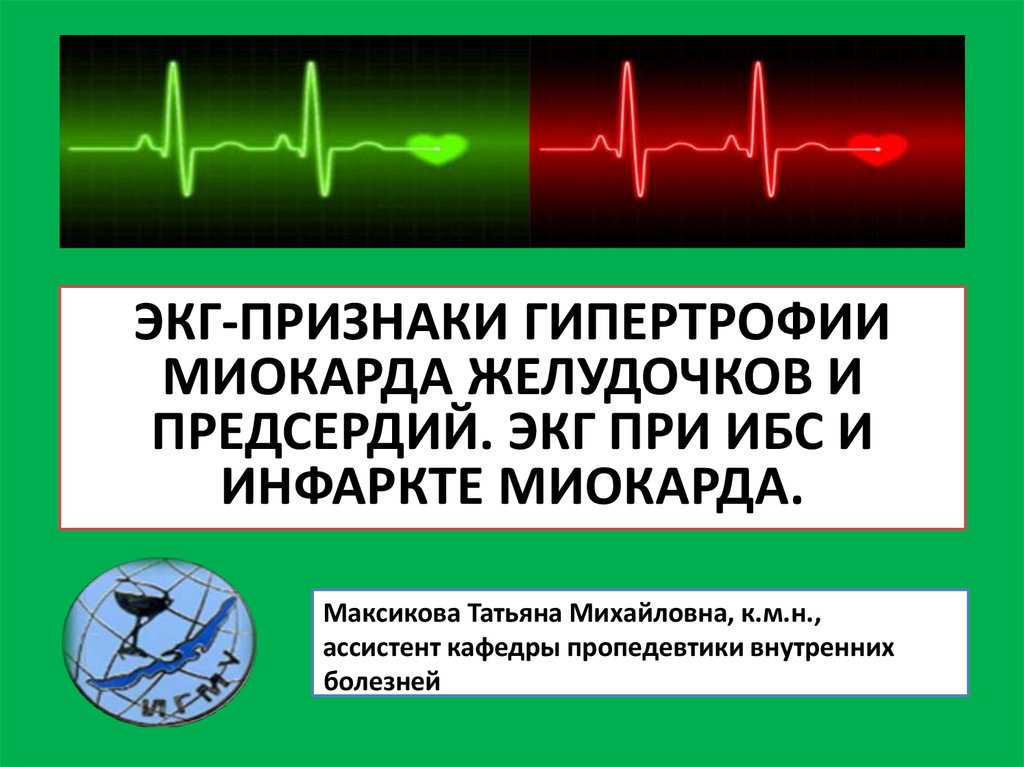  Пособие по теме ЭКГ-диагностика гипертрофии предсердий и желудочков