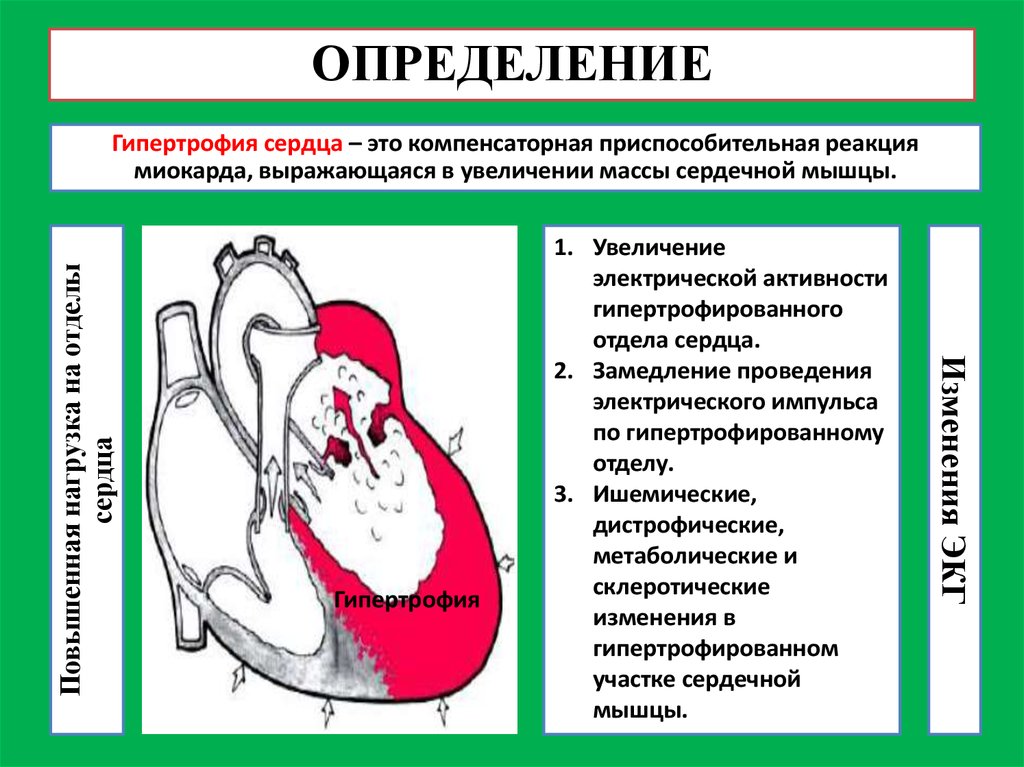 Желудочка сердца расширена. Гипертрофия левых отделов. Повышение электрической активности миокарда. Гипертрофия миокарда сердца. Повышение активности левого желудочка.