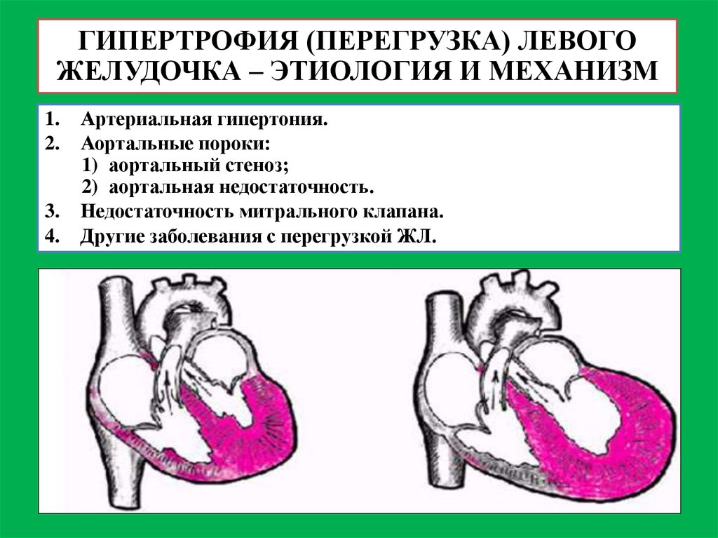 Глж сердца. Гипертоническая болезнь и гипертрофия левого желудочка. Гипертрофия левого желудочка механизм. Гипертрофия и недостаточность левого желудочка. Синдром гипертрофии миокарда левого желудочка симптомы.