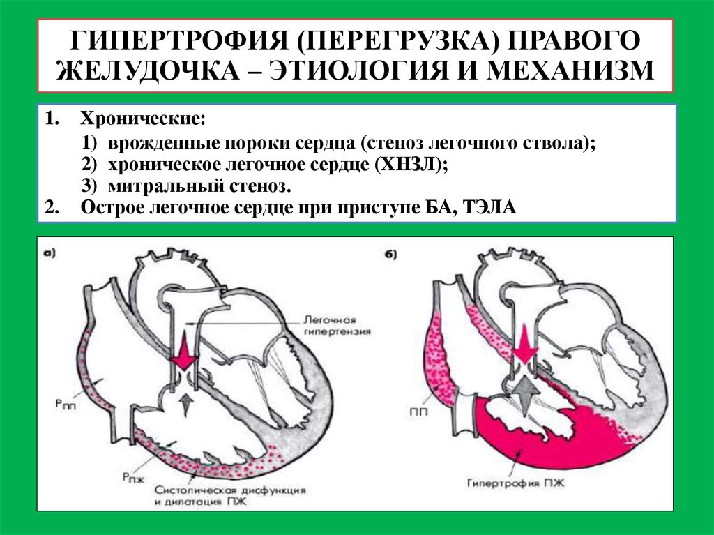 Увеличение сердечного желудочка