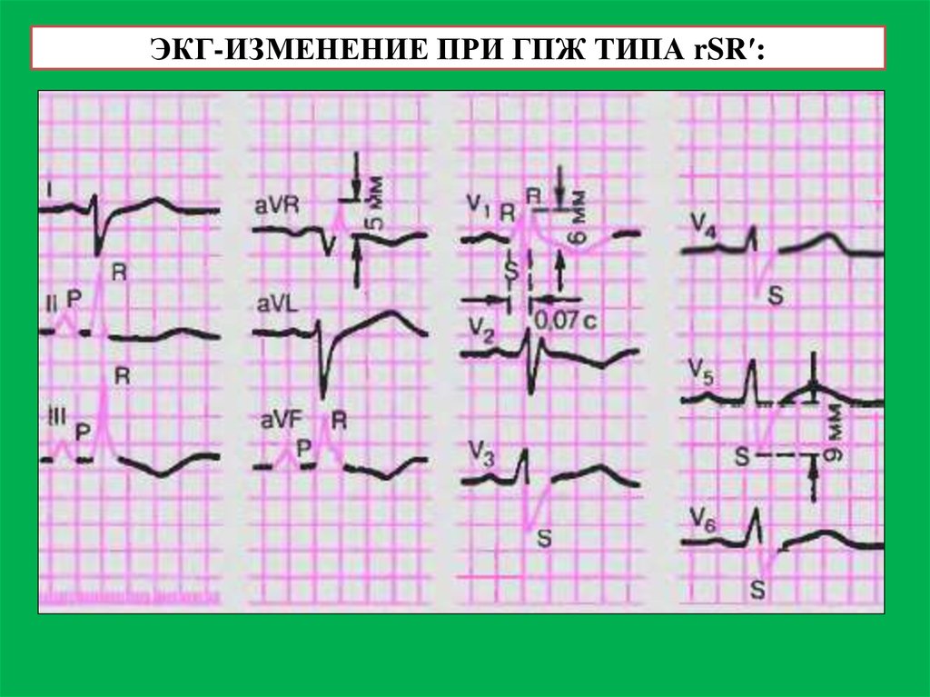 Типы экг. RSR RSR ЭКГ. Гипертрофия правого желудочка на ЭКГ RSR. RSR Тип гипертрофии правого желудочка. Гипертрофия правого желудочка на ЭКГ RSR Тип.