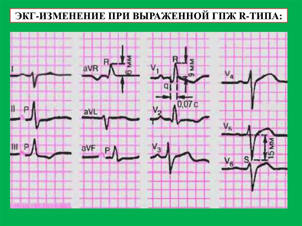 Изменения на экг