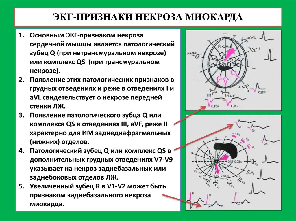 Некроз симптомы. Признаки некроза сердечной мышцы на ЭКГ. ЭКГ признаками некроза сердечной мышцы являются:. Основным ЭКГ признаком некроза сердечной мышцы является. Основной ЭКГ-признак некроза миокарда.