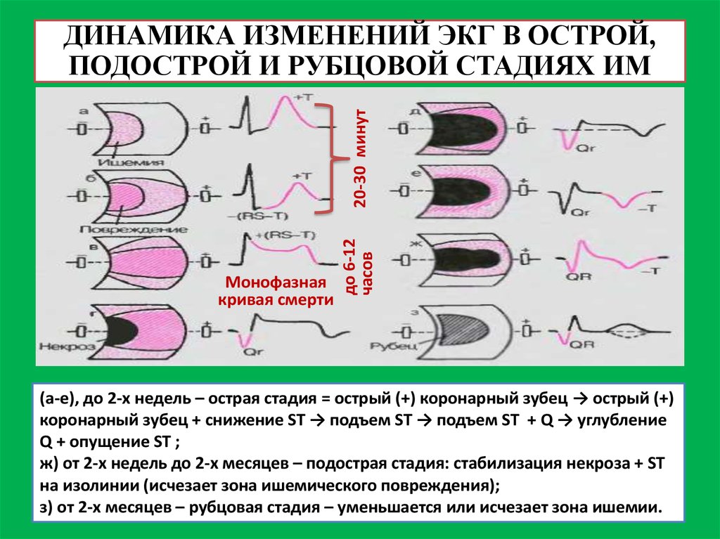 Изменение миокарда перегородочной области. Признаки рубцовых изменений миокарда на ЭКГ. Рубцовые изменения миокарда на ЭКГ. Рубцовые изменения по ЭКГ. Rubsoviye Izmeniniye na EKG.